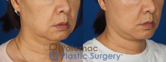 Before & After Neck Lift Case 350 Right Oblique View in Washington DC & Arlington , DC