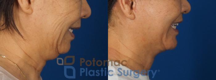 Before & After Neck Lift Case 350 Right Side View in Washington DC & Arlington , DC