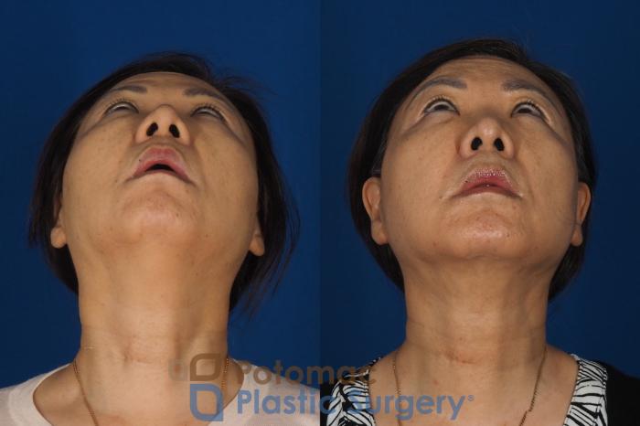 Before & After Facelift Case 354 Bottom View in Washington DC & Arlington , DC
