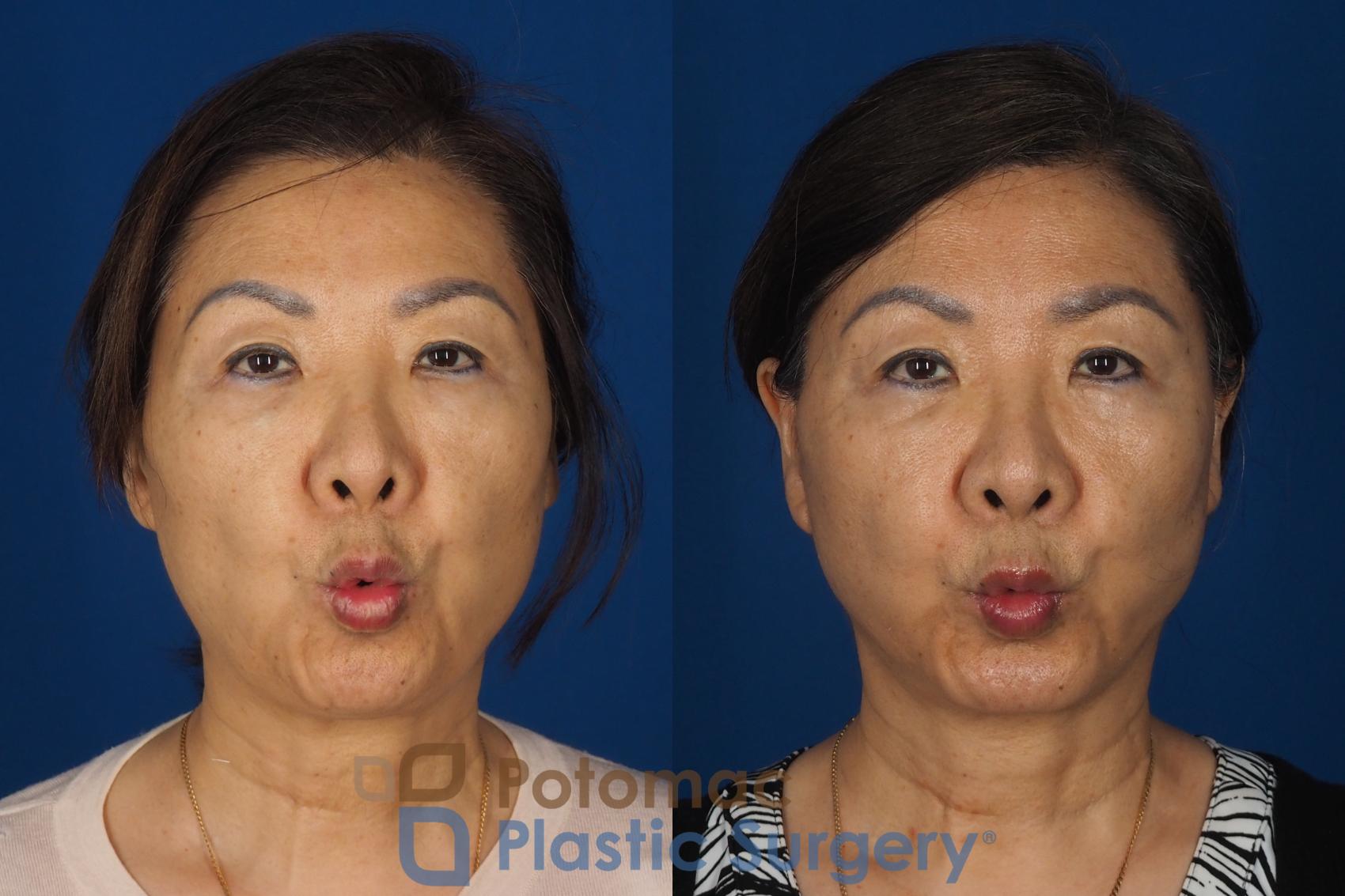 Before & After Facelift Case 354 Front - Puckering View in Washington DC & Arlington , DC