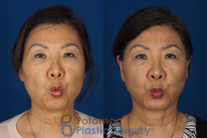 Before & After Facelift Case 354 Front - Puckering View in Washington DC & Arlington , DC