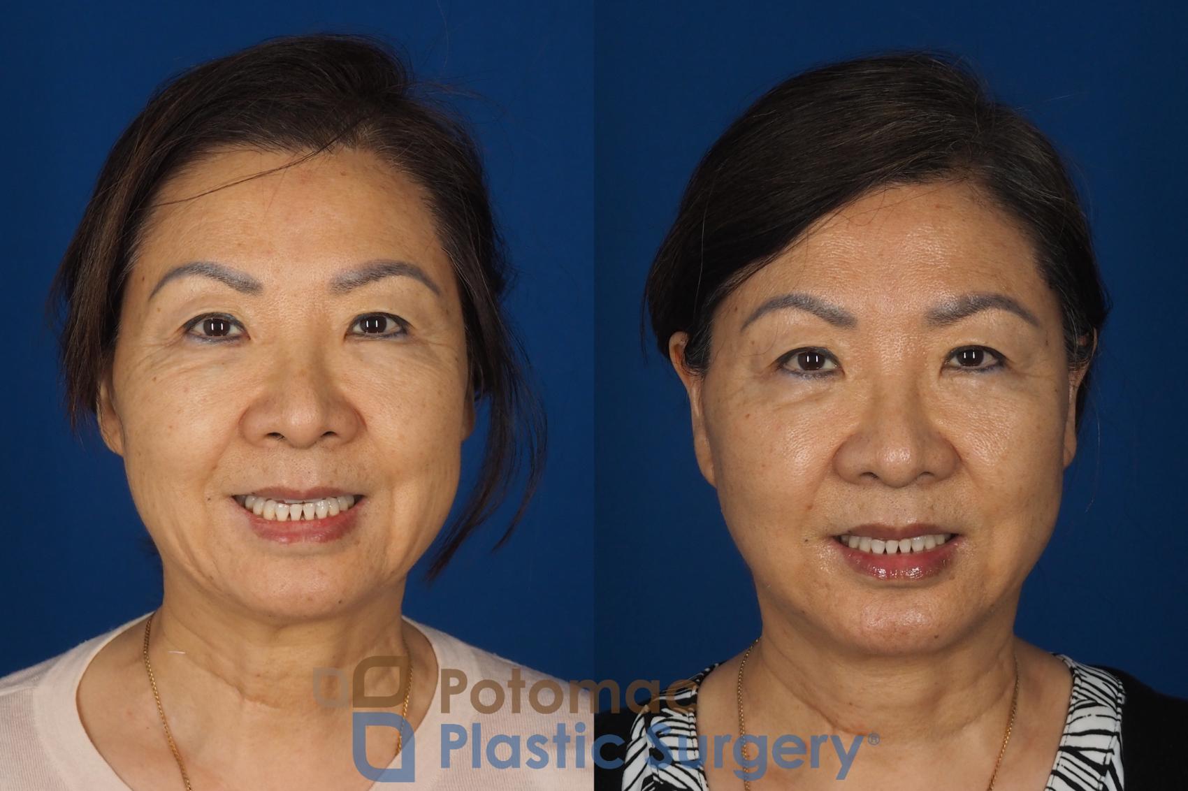 Before & After Facelift Case 354 Front - Smiling View in Washington DC & Arlington , DC