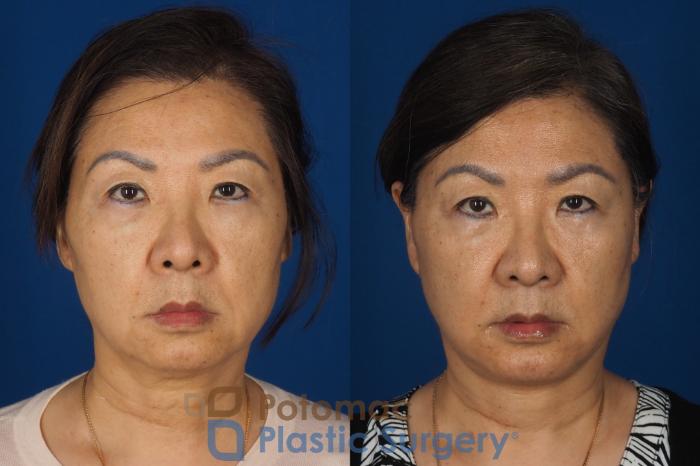 Before & After Facelift Case 354 Front View in Washington DC & Arlington , DC