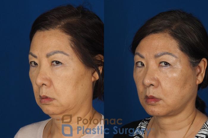 Before & After Facelift Case 354 Left Oblique 2 View in Washington DC & Arlington , DC