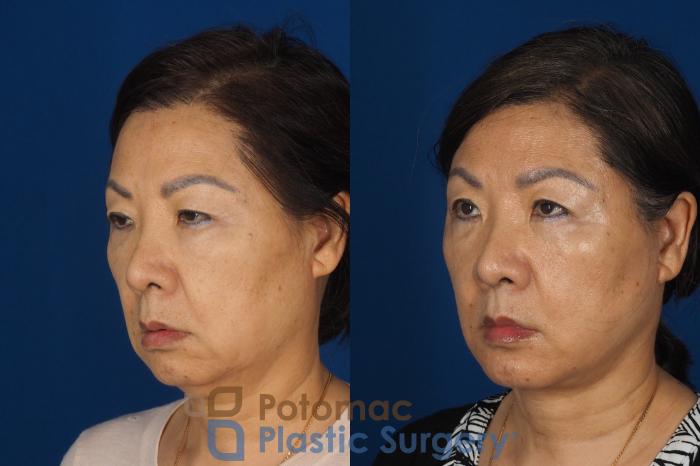 Before & After Facelift Case 354 Left Oblique View in Washington DC & Arlington , DC