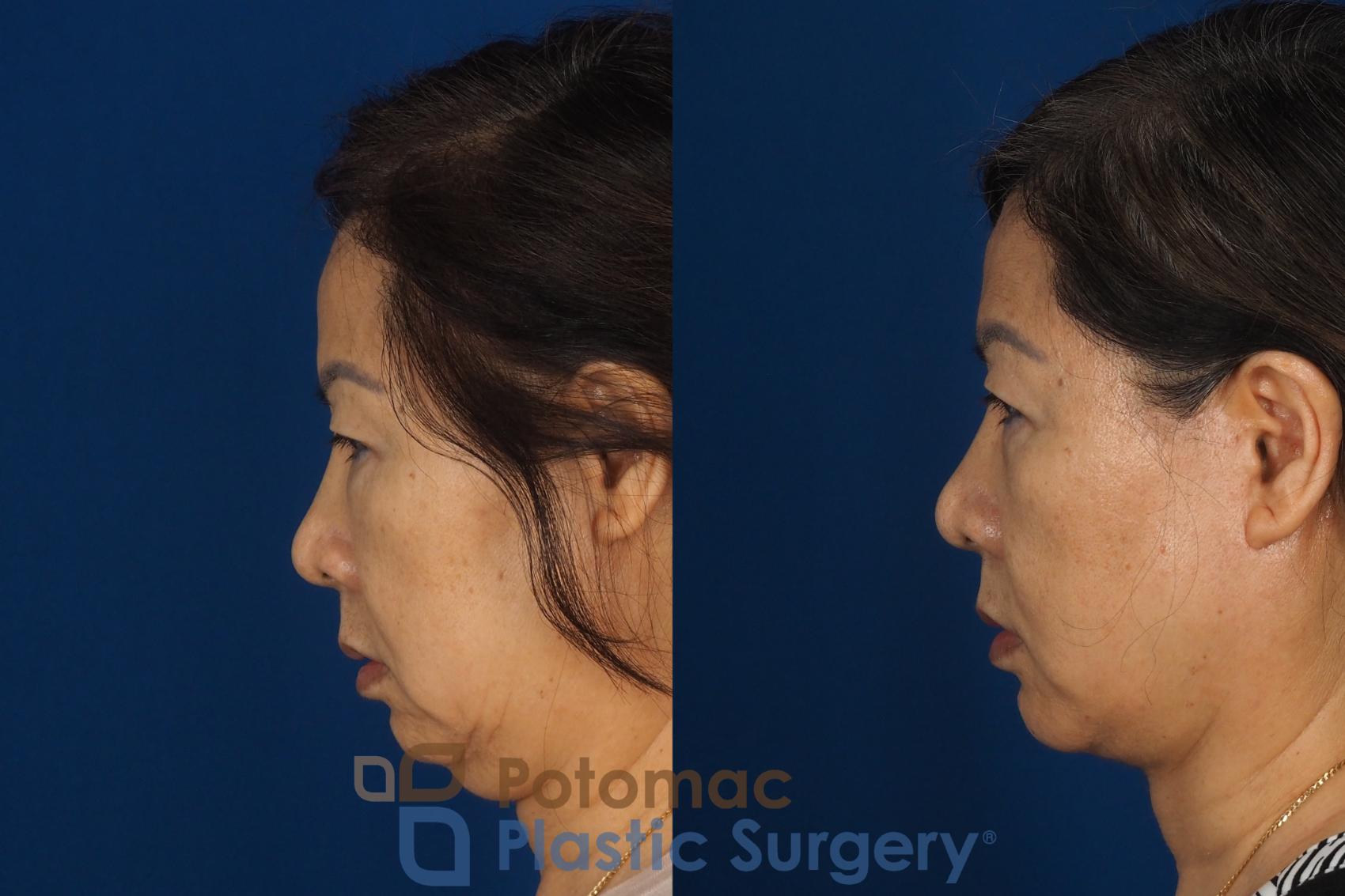 Before & After Facelift Case 354 Left Side View in Washington DC & Arlington , DC