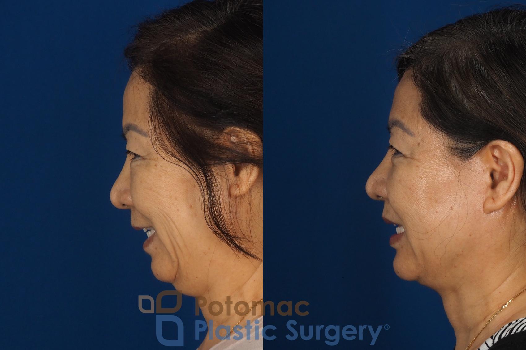 Before & After Facelift Case 354 Left - Smiling View in Washington DC & Arlington , DC