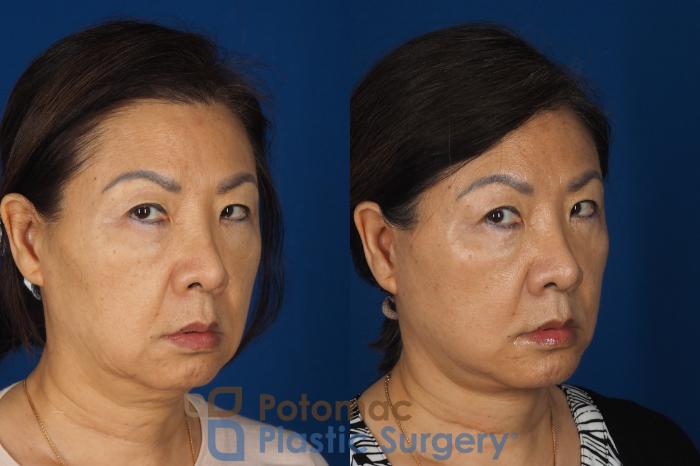 Before & After Facelift Case 354 Right Oblique 2 View in Washington DC & Arlington , DC