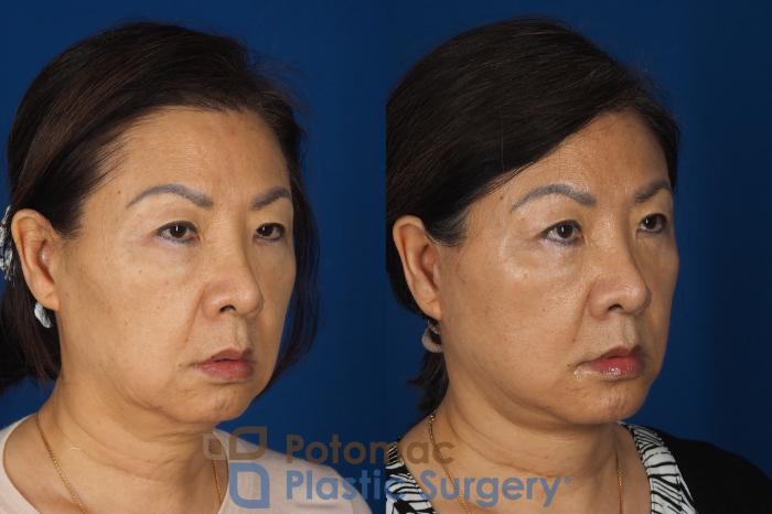 Before & After Facelift Case 354 Right Oblique View in Washington DC & Arlington , DC