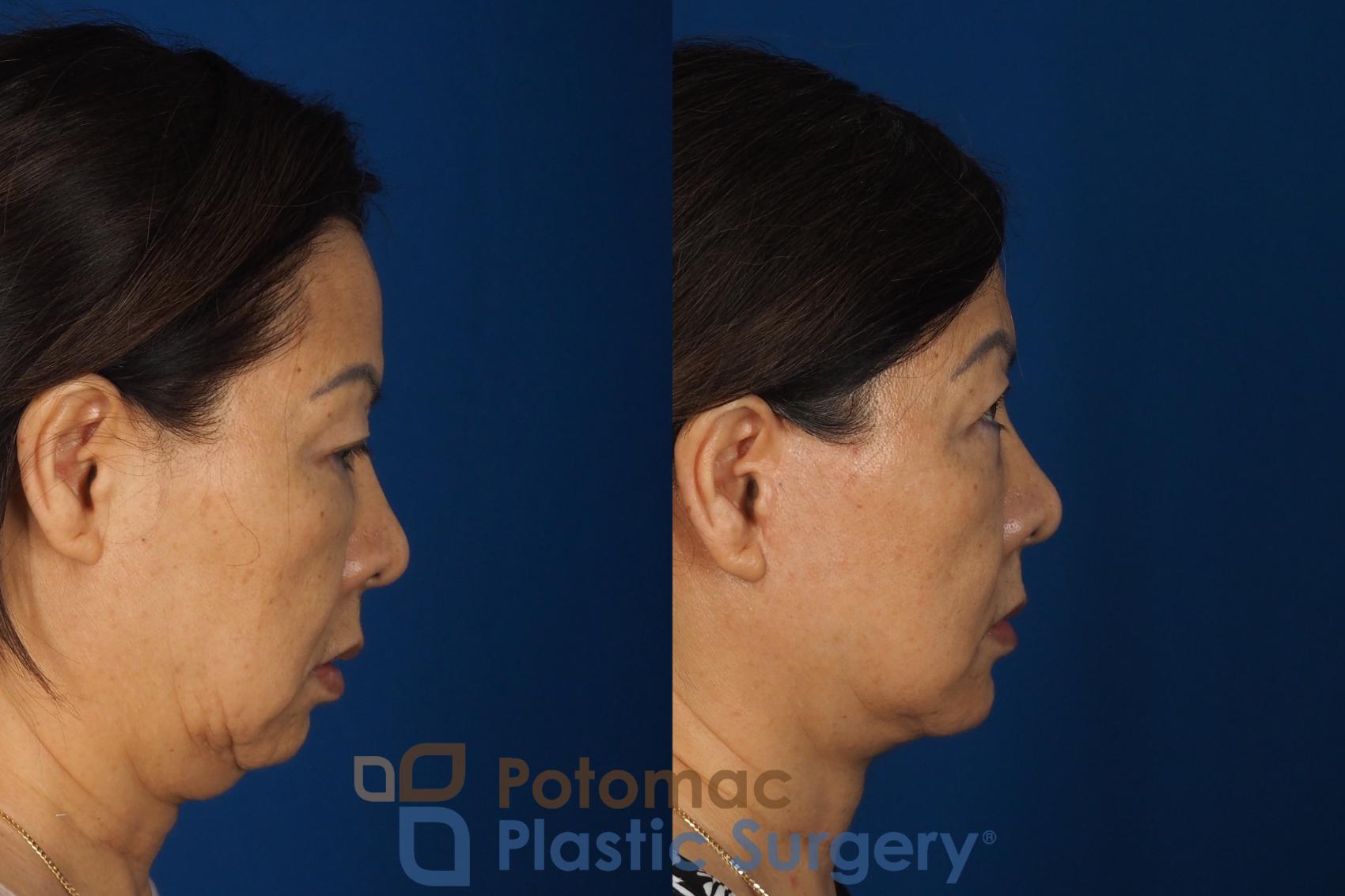 Before & After Facelift Case 354 Right Side View in Washington DC & Arlington , DC