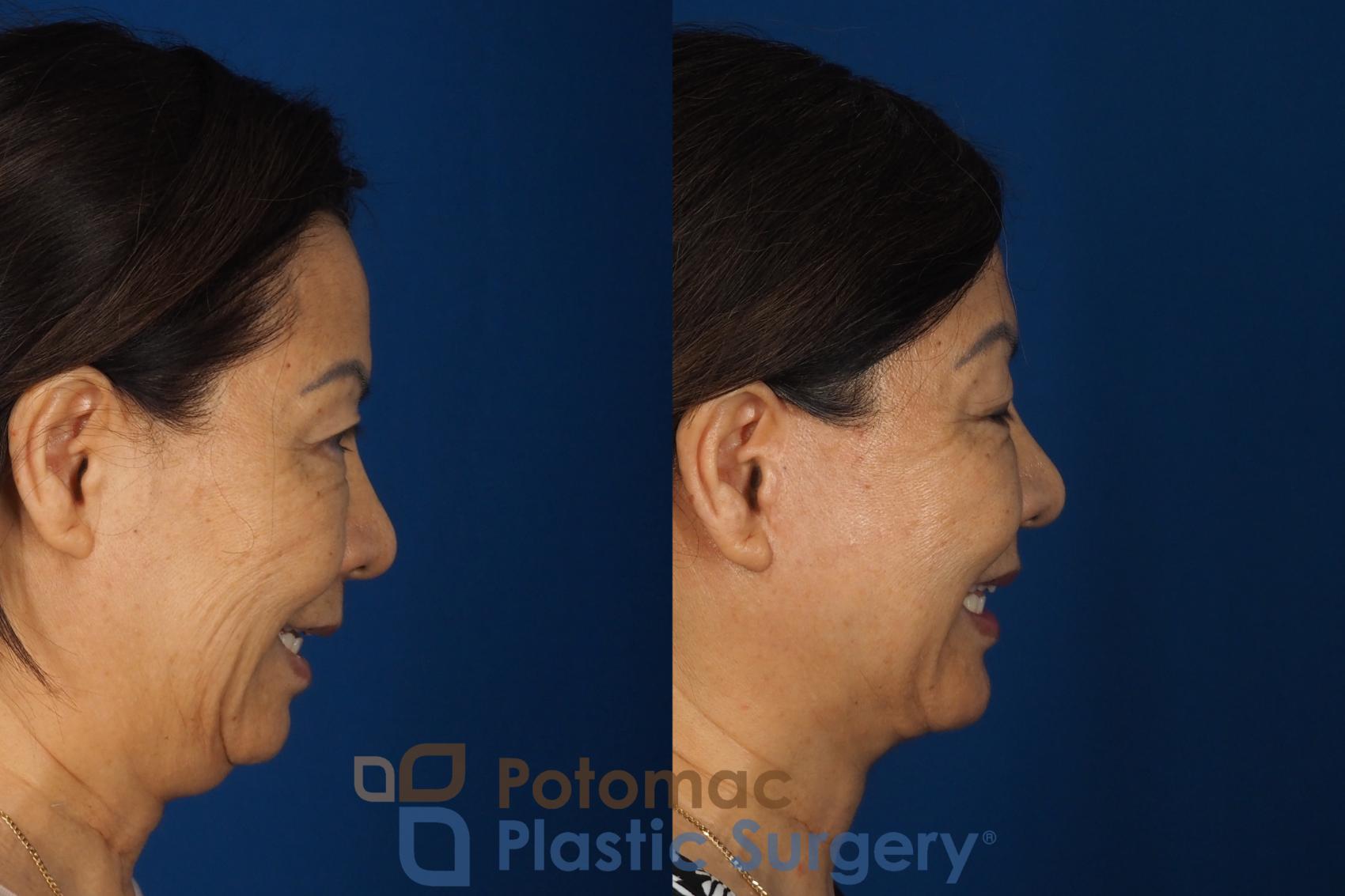 Before & After Facelift Case 354 Right - Smiling View in Washington DC & Arlington , DC