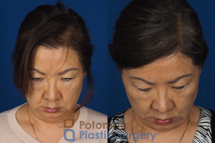 Before & After Facelift Case 354 Top View in Washington DC & Arlington , DC
