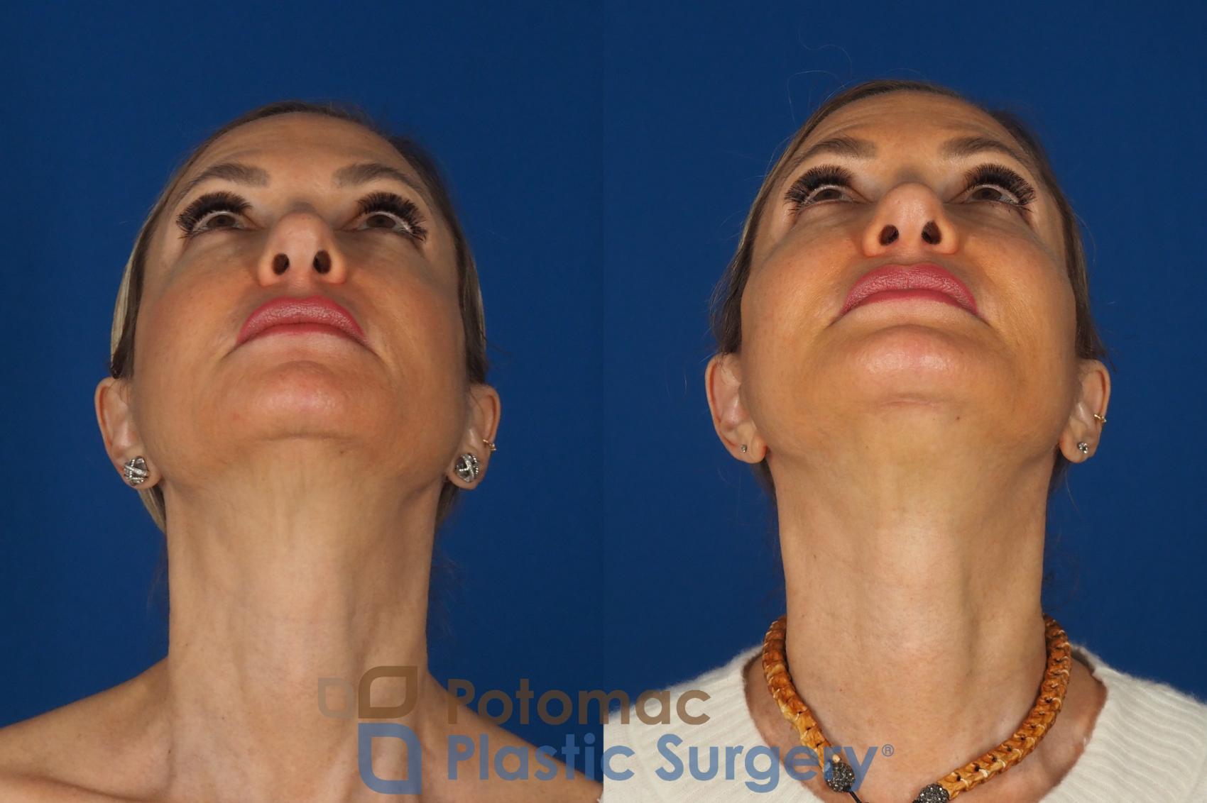 Before & After Facelift Case 362 Bottom View in Washington DC & Arlington , DC