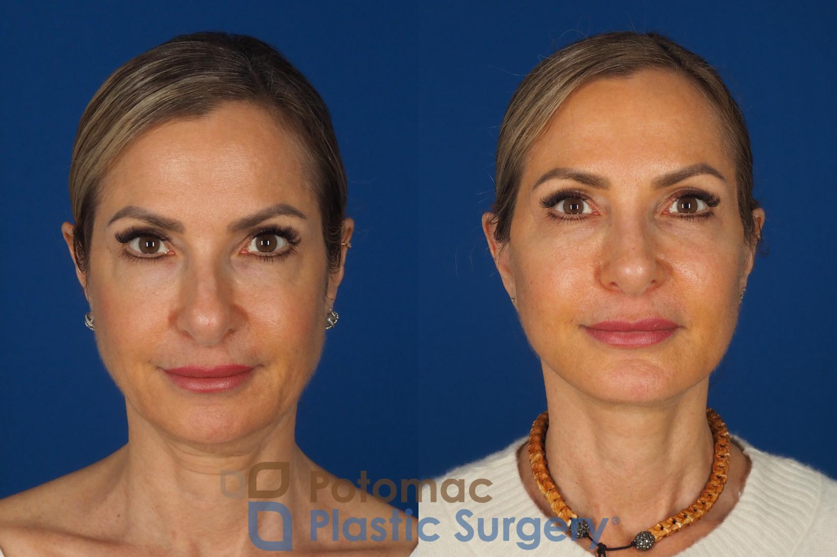 Before & After Facelift Case 362 Front View in Washington DC & Arlington , DC