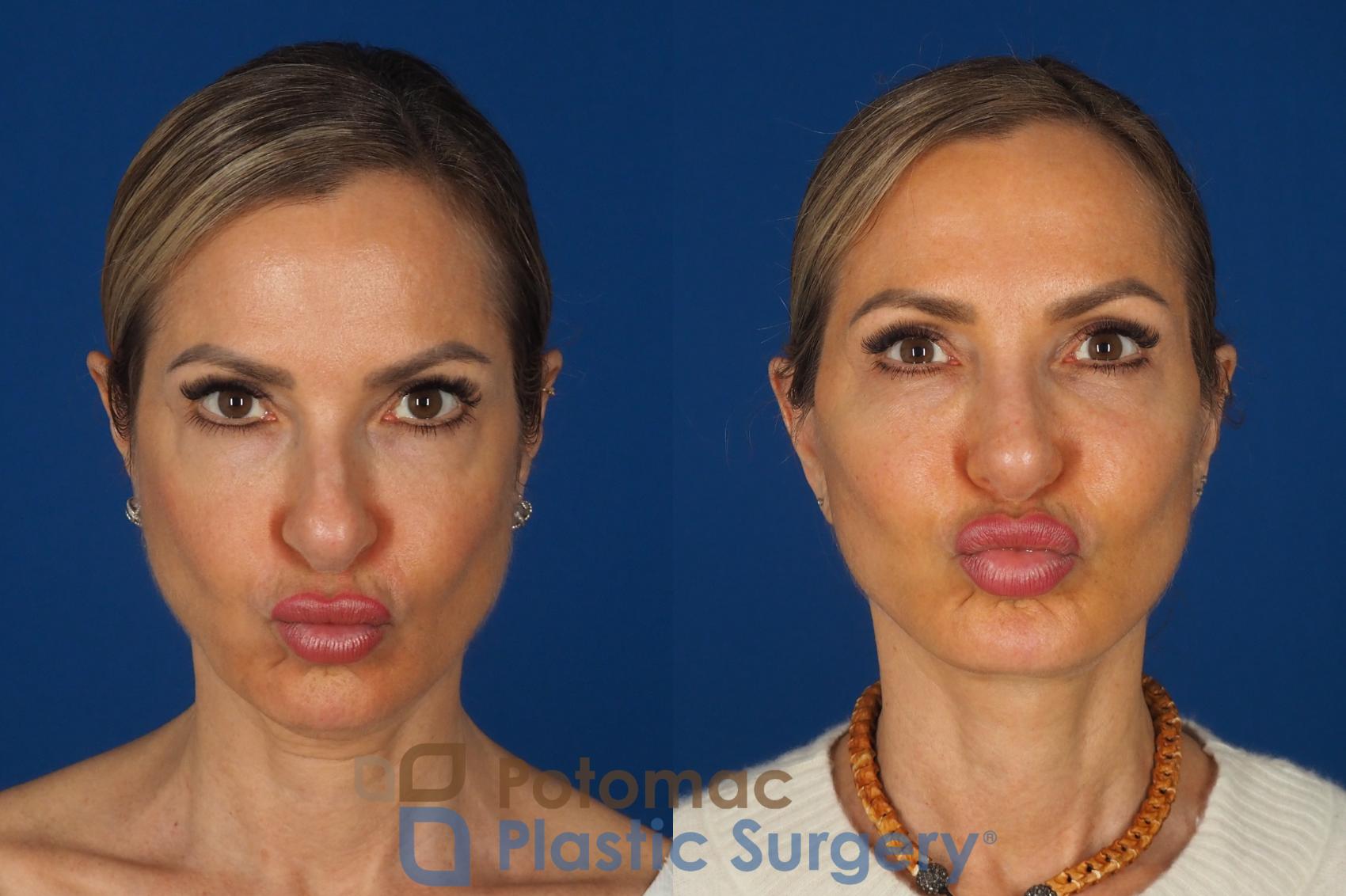 Before & After Facelift Case 362 Front - Puckering View in Washington DC & Arlington , DC