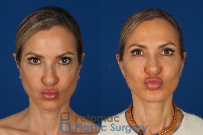 Before & After Facelift Case 362 Front - Puckering View in Washington DC & Arlington , DC