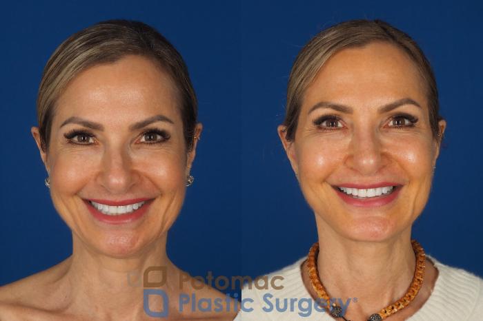 Before & After Facelift Case 362 Front - Smiling View in Washington DC & Arlington , DC