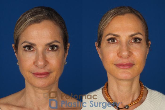 Before & After Facelift Case 362 Front View in Washington DC & Arlington , DC
