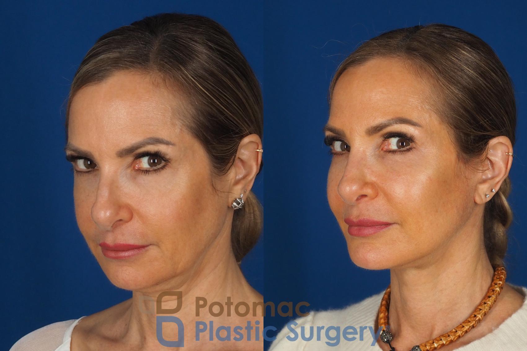 Before & After Facelift Case 362 Left Oblique 2 View in Washington DC & Arlington , DC
