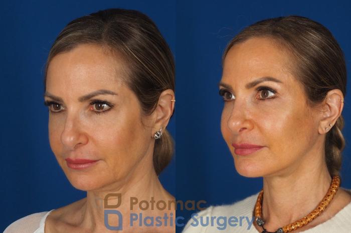 Before & After Facelift Case 362 Left Oblique View in Washington DC & Arlington , DC