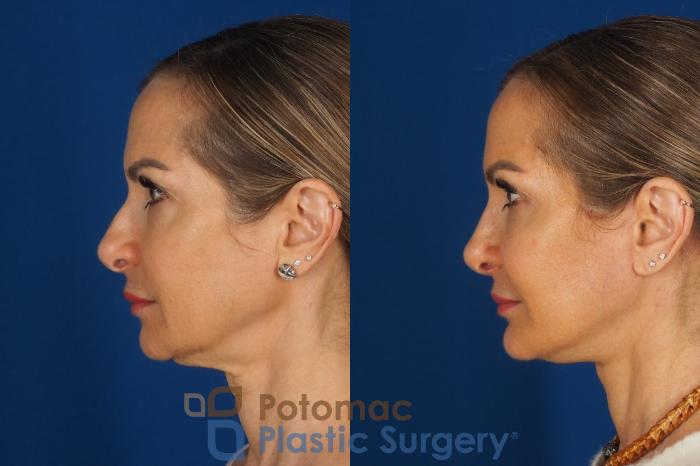 Before & After Facelift Case 362 Left Side View in Washington DC & Arlington , DC
