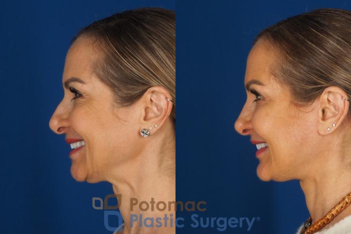 Before & After Facelift Case 362 Left - Smiling View in Washington DC & Arlington , DC