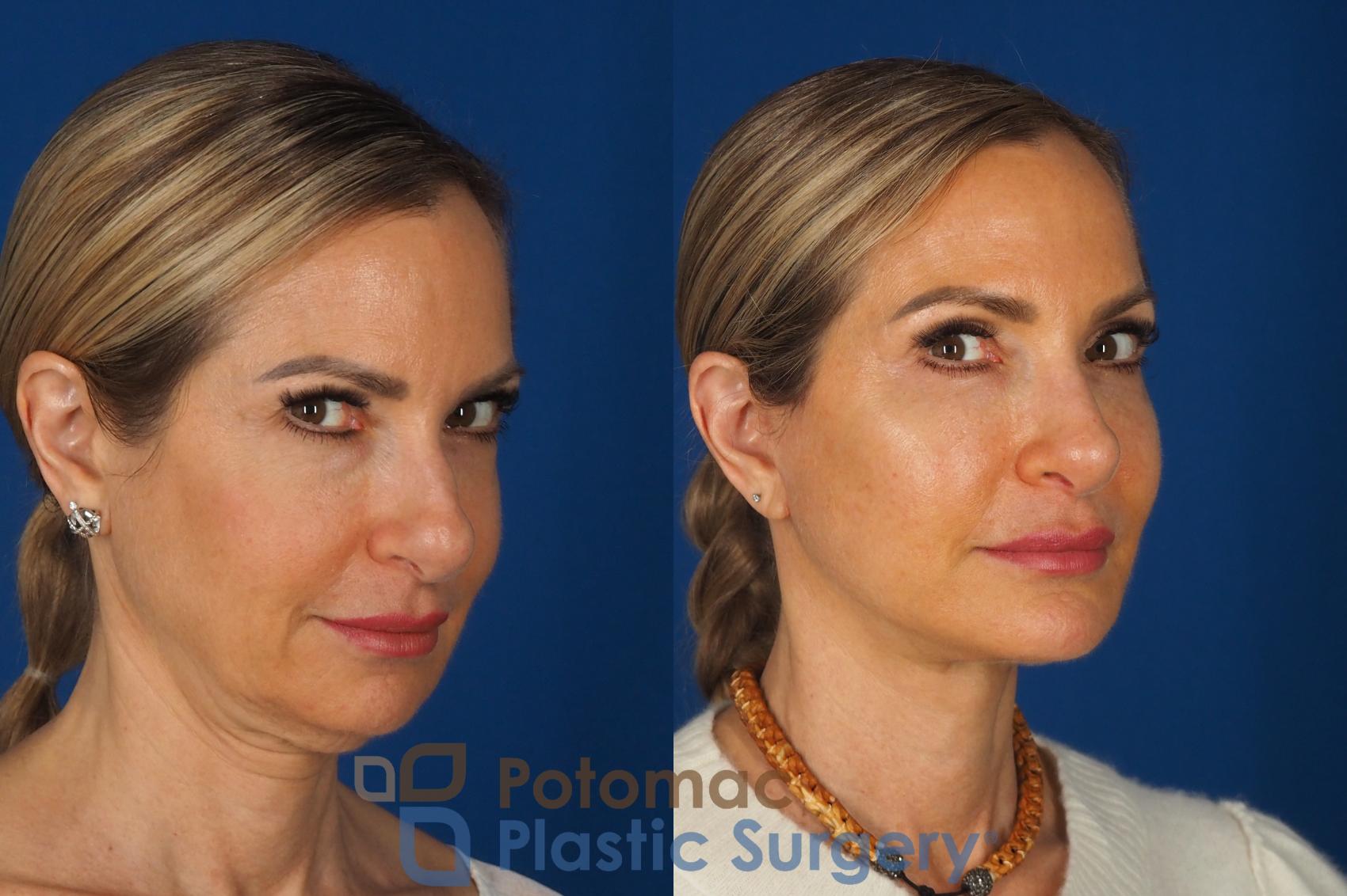 Before & After Facelift Case 362 Right Oblique 2 View in Washington DC & Arlington , DC