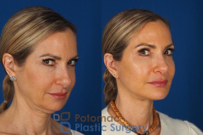 Before & After Facelift Case 362 Right Oblique 2 View in Washington DC & Arlington , DC