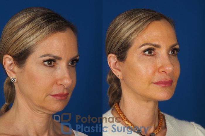Before & After Facelift Case 362 Right Oblique View in Washington DC & Arlington , DC