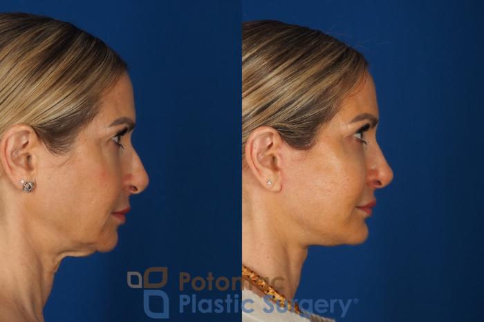Before & After Facelift Case 362 Right Side View in Washington DC & Arlington , DC