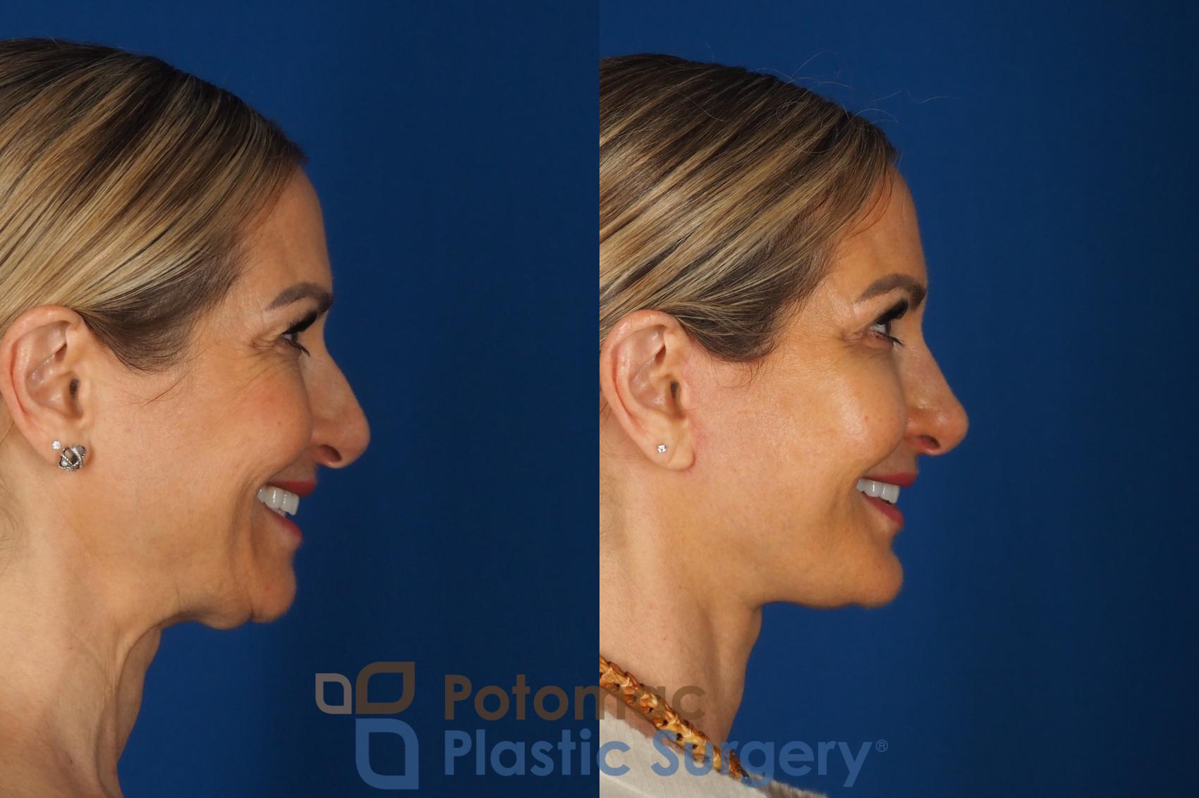 Before & After Facelift Case 362 Right - Smiling View in Washington DC & Arlington , DC
