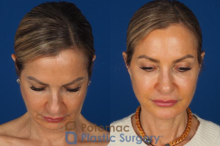 Before & After Facelift Case 362 Top View in Washington DC & Arlington , DC