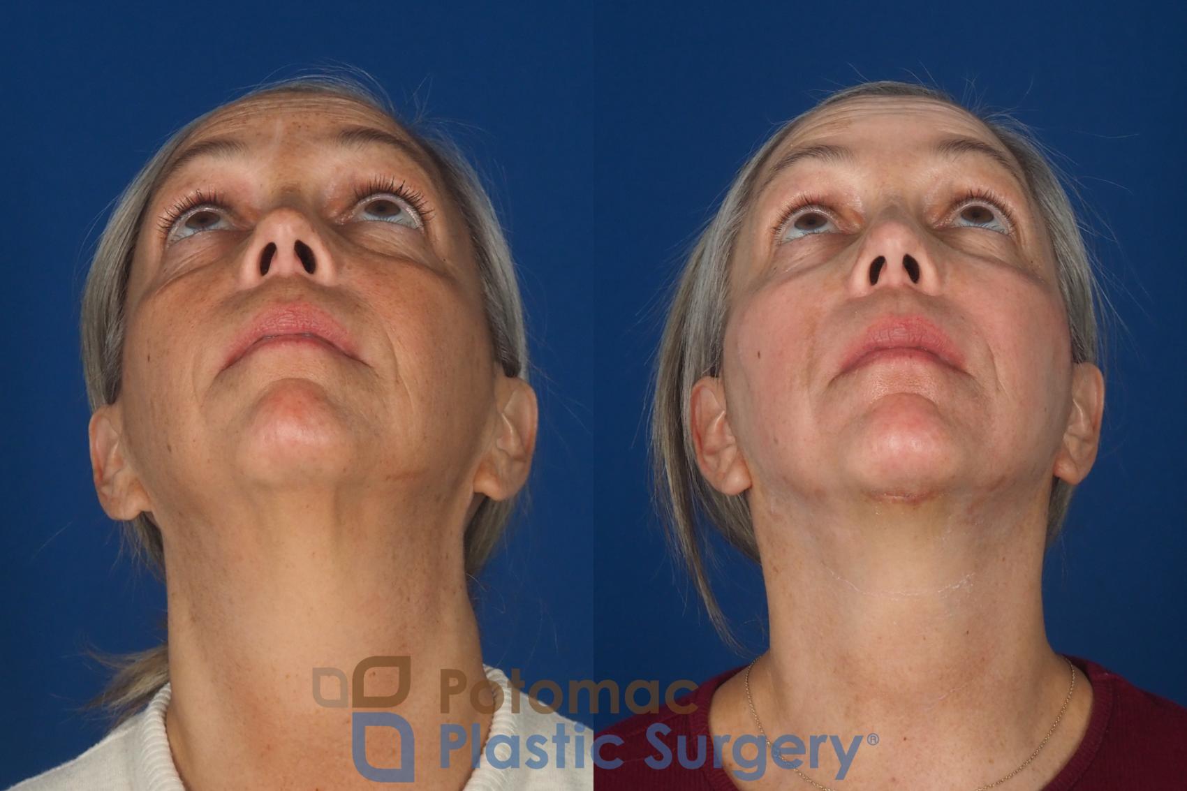 Before & After Facelift Case 363 Bottom View in Washington DC & Arlington , DC