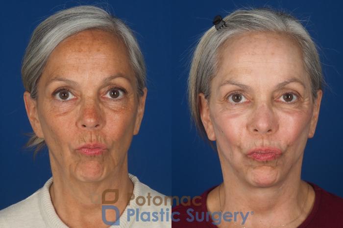 Before & After Facelift Case 363 Front - Puckering View in Washington DC & Arlington , DC