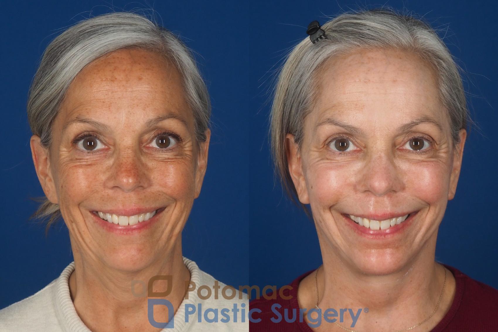 Before & After Facelift Case 363 Front - Smiling View in Washington DC & Arlington , DC
