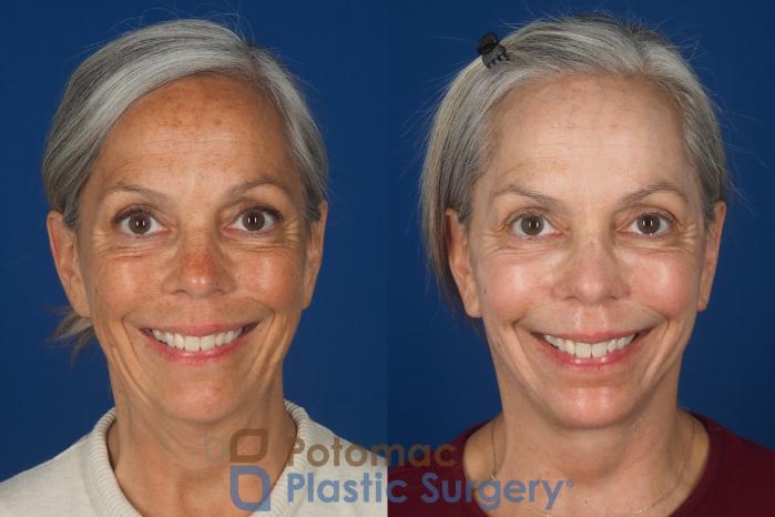 Before & After Facelift Case 363 Front - Smiling View in Washington DC & Arlington , DC