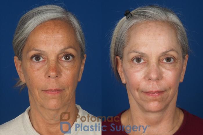 Before & After Facelift Case 363 Front View in Washington DC & Arlington , DC
