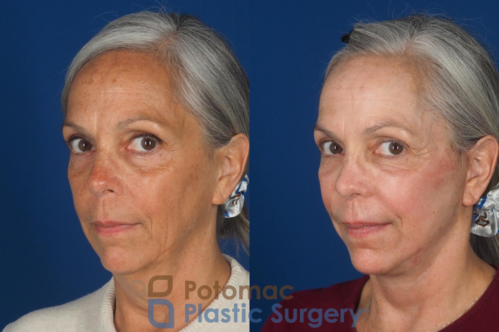 Before & After Facelift Case 363 Left Oblique 2 View in Washington DC & Arlington , DC