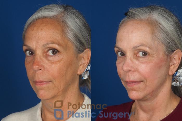Before & After Facelift Case 363 Left Oblique 2 View in Washington DC & Arlington , DC