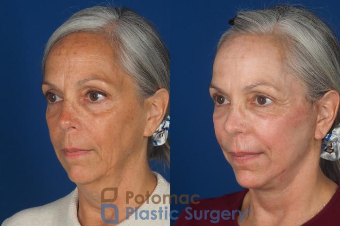 Before & After Facelift Case 363 Left Oblique View in Washington DC & Arlington , DC