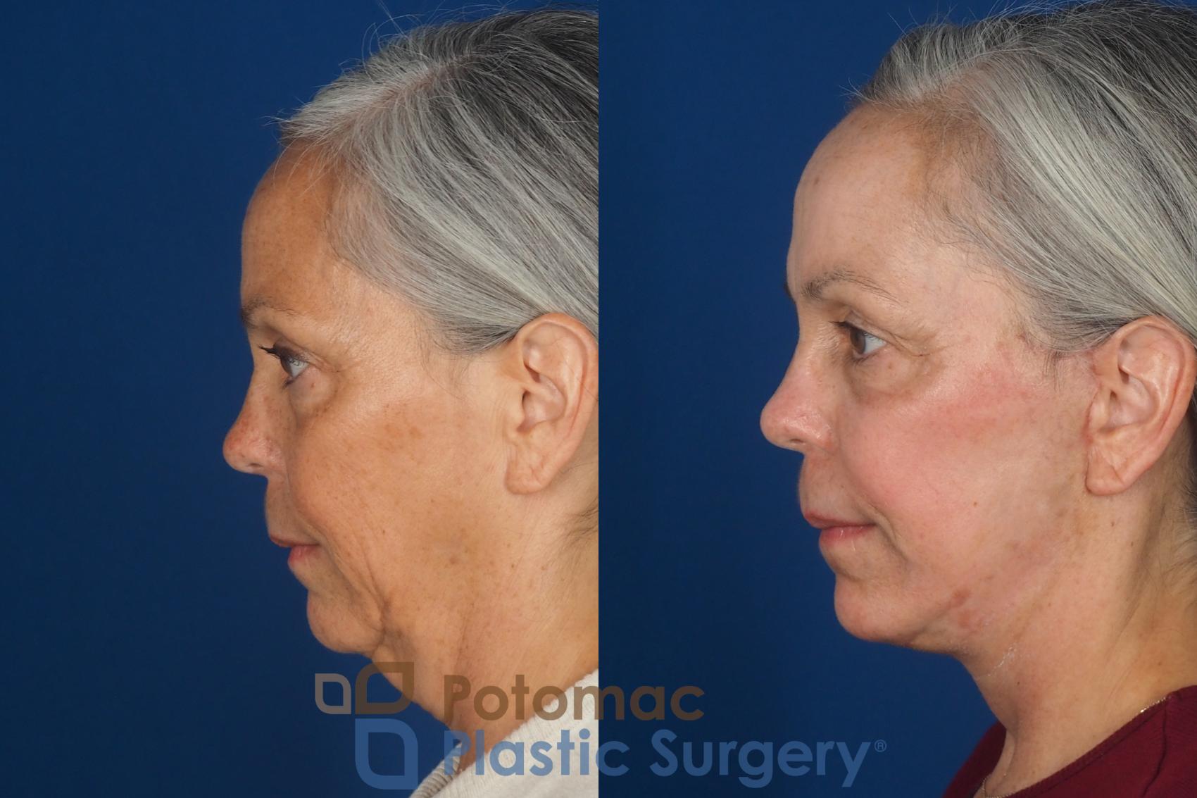 Before & After Facelift Case 363 Left Side View in Washington DC & Arlington , DC