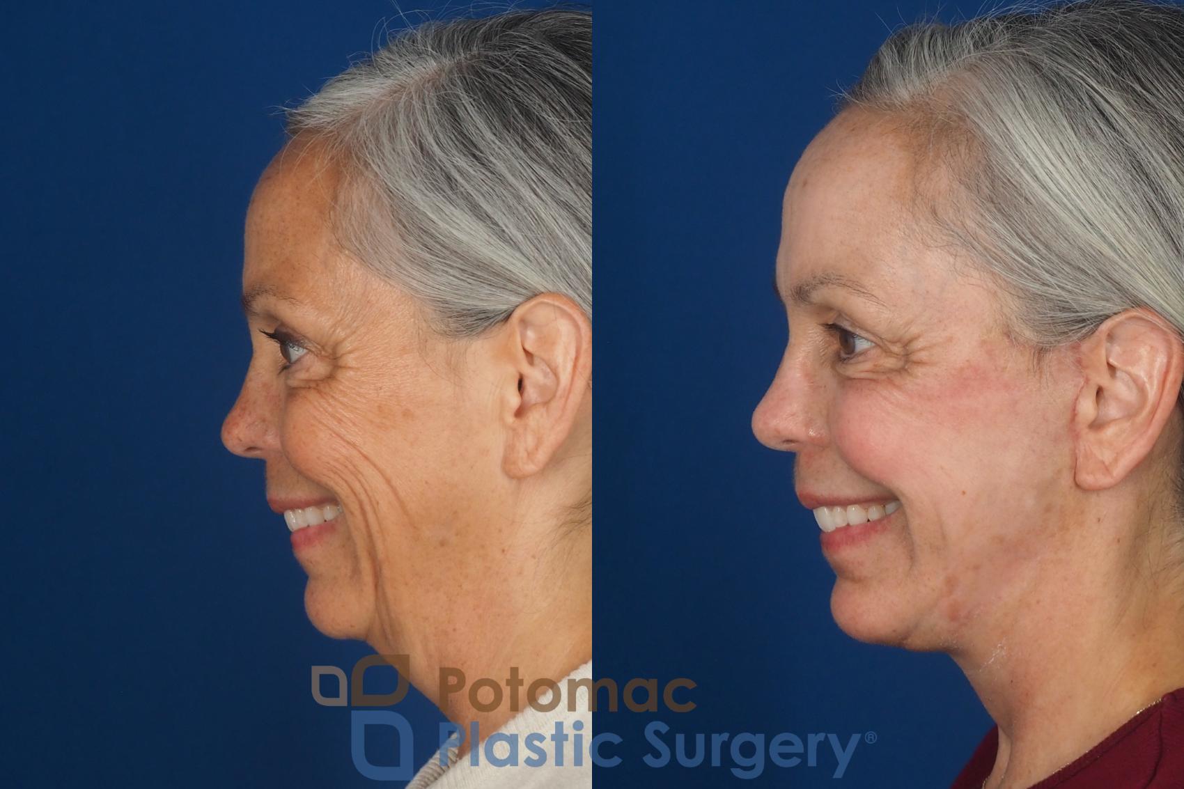 Before & After Facelift Case 363 Left - Smiling View in Washington DC & Arlington , DC