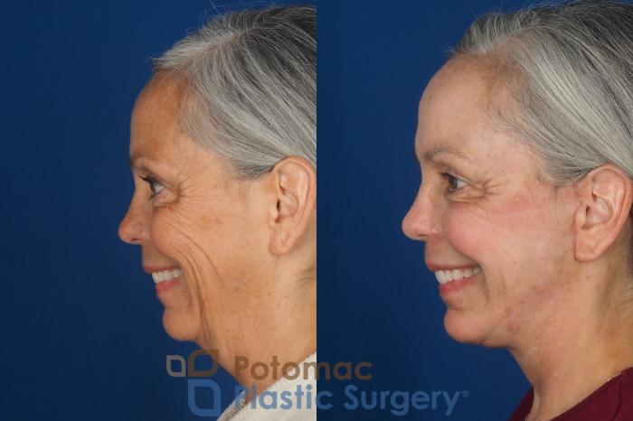 Before & After Facelift Case 363 Left - Smiling View in Washington DC & Arlington , DC