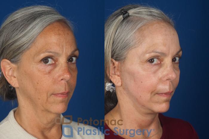 Before & After Facelift Case 363 Right Oblique 2 View in Washington DC & Arlington , DC
