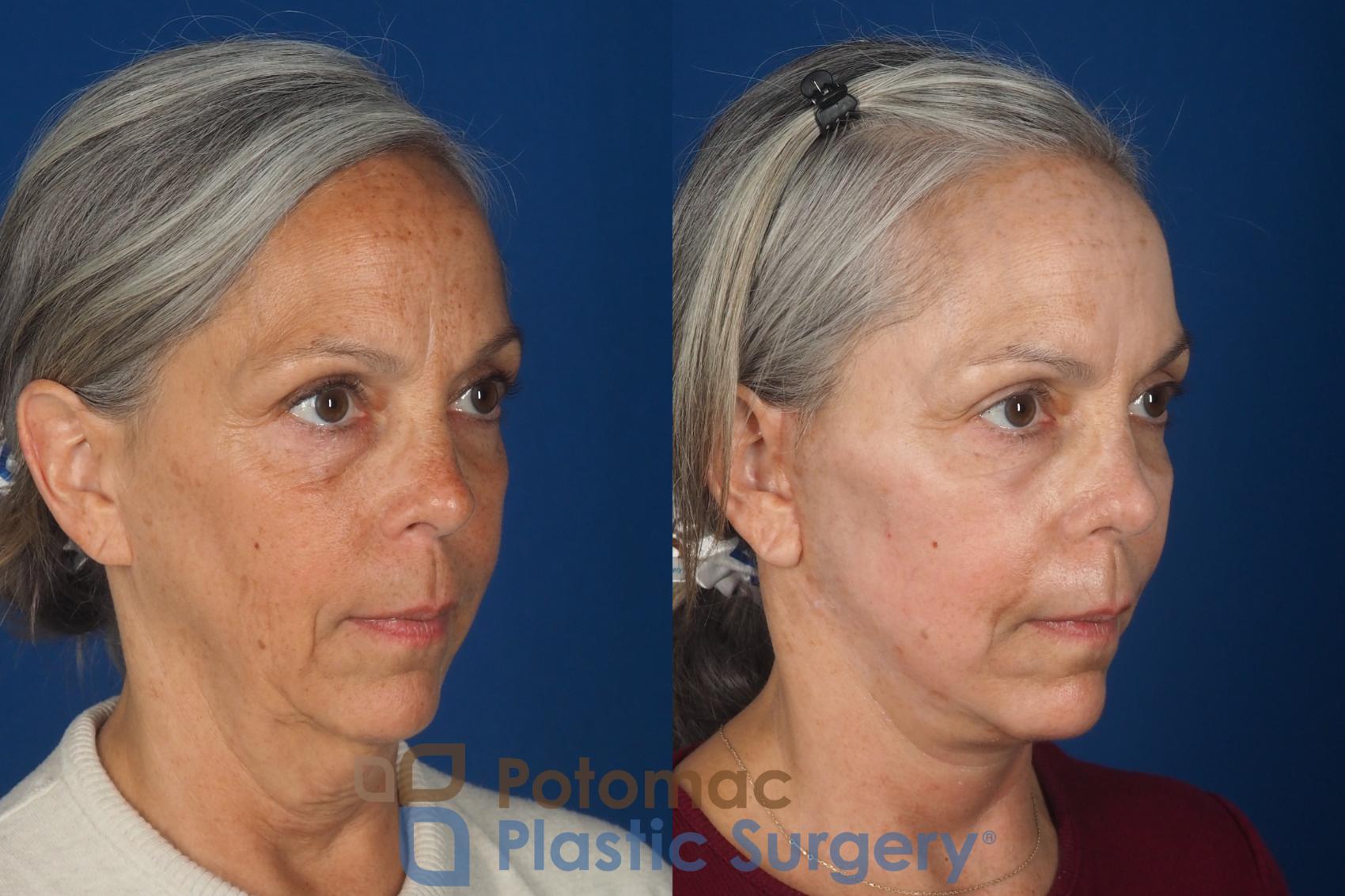 Before & After Facelift Case 363 Right Oblique View in Washington DC & Arlington , DC