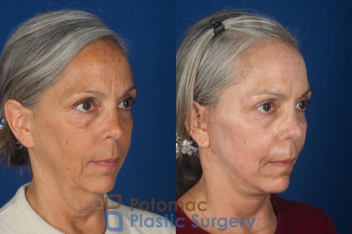 Before & After Facelift Case 363 Right Oblique View in Washington DC & Arlington , DC