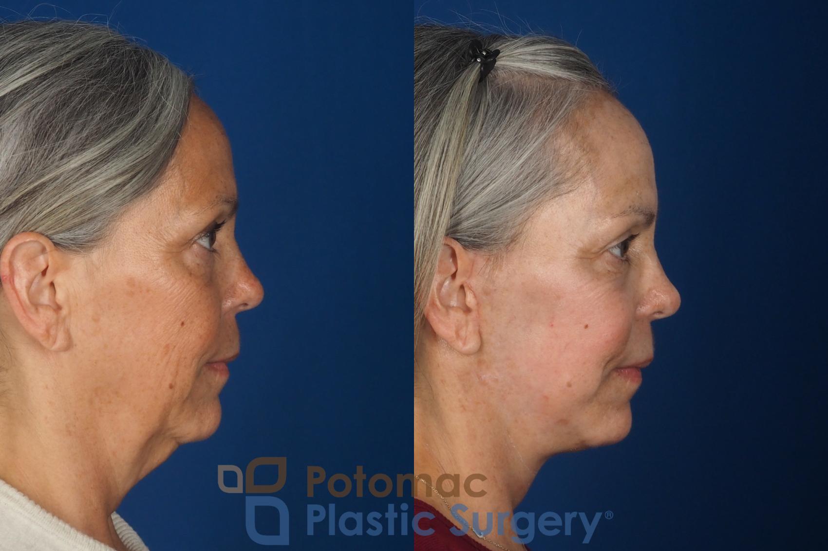 Before & After Facelift Case 363 Right Side View in Washington DC & Arlington , DC