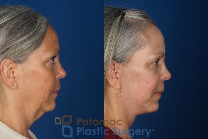 Before & After Facelift Case 363 Right Side View in Washington DC & Arlington , DC