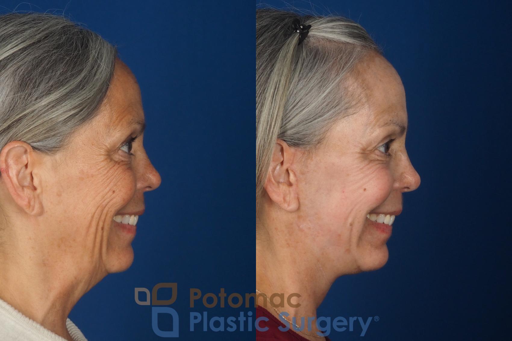 Before & After Facelift Case 363 Right - Smiling View in Washington DC & Arlington , DC