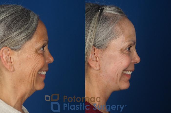 Before & After Facelift Case 363 Right - Smiling View in Washington DC & Arlington , DC